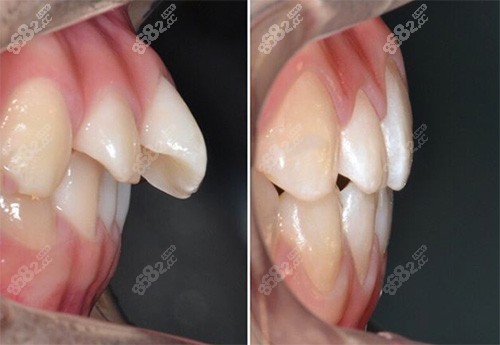 牙齿矫正侧面状态前后对比