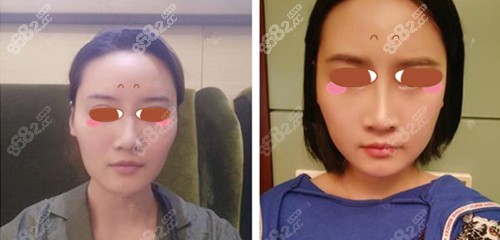 上海华美李志海颧骨内推案例