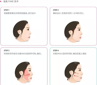 韩国迪美整形面部提升手术流程