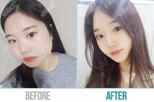 韩国原辰整形外科面部轮廓案例