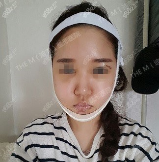韩国迪美整形面部轮廓10件套术后三天照