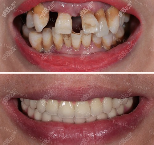 长沙牙祖口腔医院牙齿种植案例