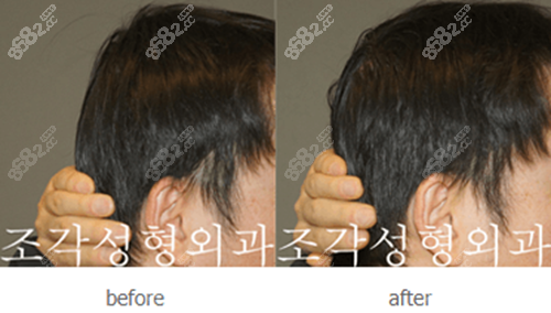 韩国雕刻宋龙泰骨水泥填充后脑勺术前术后对比