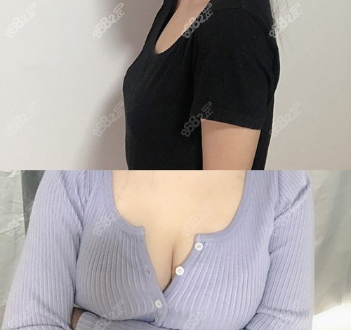 温岭芘丽芙胸部整形对比