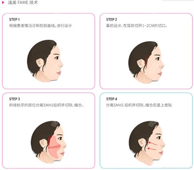 韩国迪美整形医院面部拉提手术流程