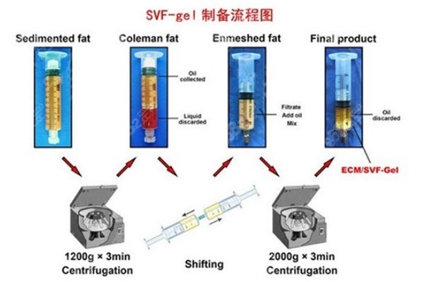 上海九院制备SVF-gel脂肪填充流程