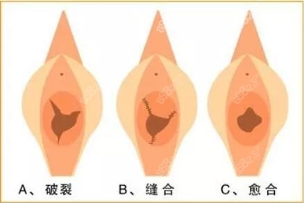 破裂与修补后的处女膜对比