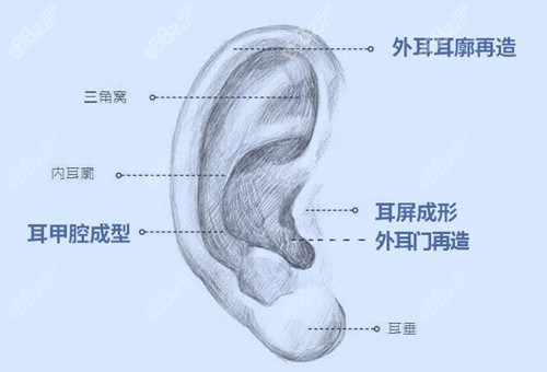 全耳再造的要素