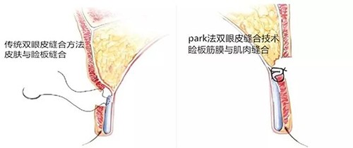 park双眼皮和全切的区别