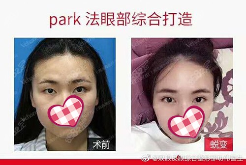 park双眼皮真人案例