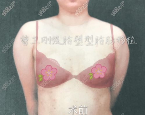 我在做脂肪丰胸前