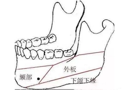韩国迪美整形下颌角术图示