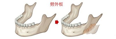 韩国迪美整形劈外板术图示