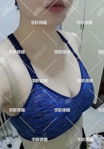 脂肪丰胸2个月