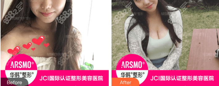 北京华韩余恩旭医生假体丰胸好不好？<span style=