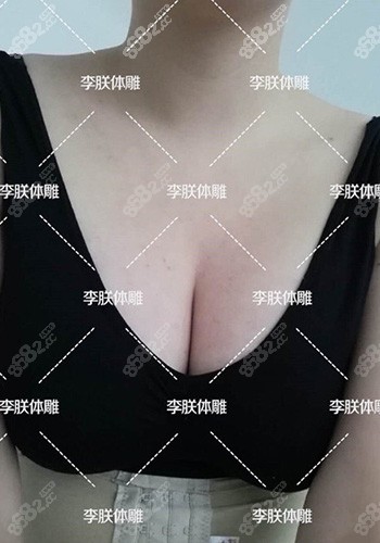 脂肪丰胸15天