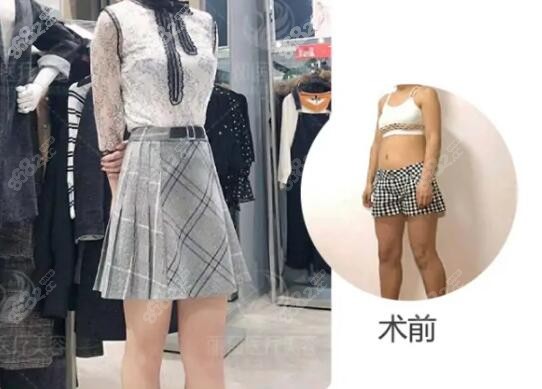 北京米蘭柏羽麗都DV光感凝脂吸脂術案例：