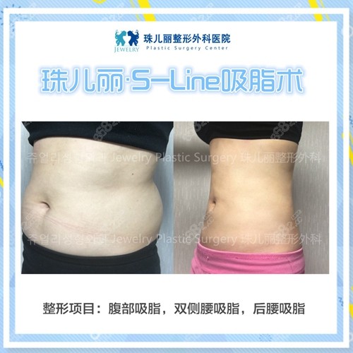 韓國珠兒麗整形外科醫(yī)院腰腹吸脂案例