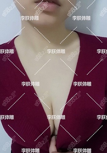 脂肪丰胸4个月