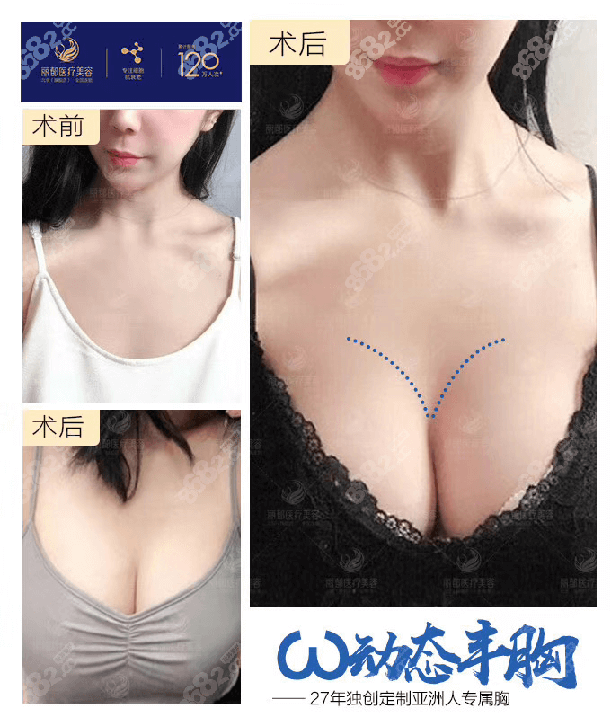 北京米兰柏羽丽都高超医生W动态假体丰胸怎么样？<span style=