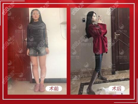 北京米蘭柏羽麗都DV光感凝脂吸脂術案例