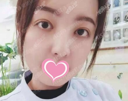 双眼皮修复术后一周恢复照