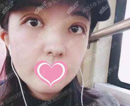 双眼皮修复术后第1天