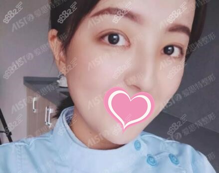 双眼皮修复术后第9天恢复照