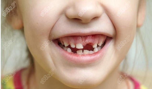 孩子牙齿不整齐,需要等到12岁换完牙再做矫正吗?医生解答