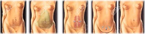 腹壁整形的不同手术切口