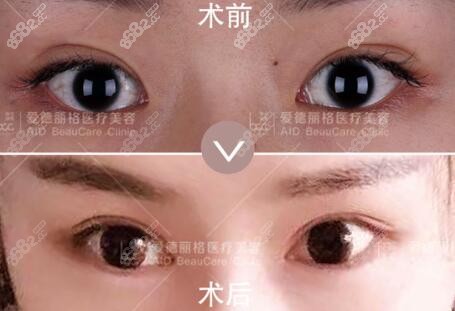 王香平双眼皮修复真人前后对比照