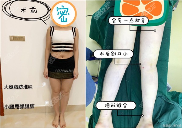 大腿环吸，小腿吸脂共3000毫升吸脂方案