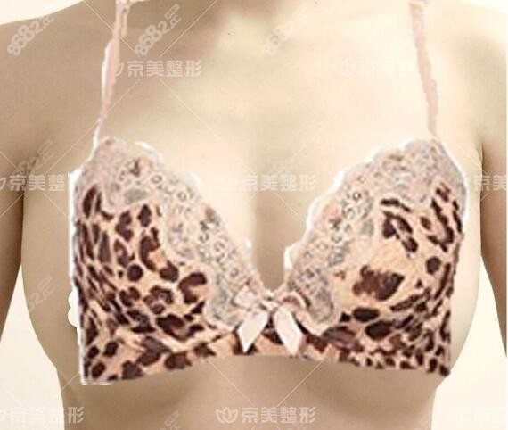 取出胸假体后同时做自体脂肪丰胸1年效果