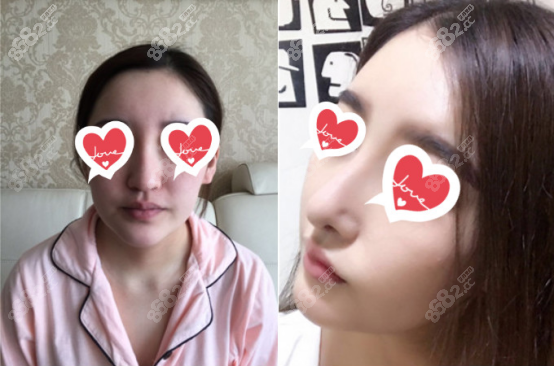 <!--<i data=20240705-sp></i>-->醫(yī)生做射極峰假體隆鼻案例二：