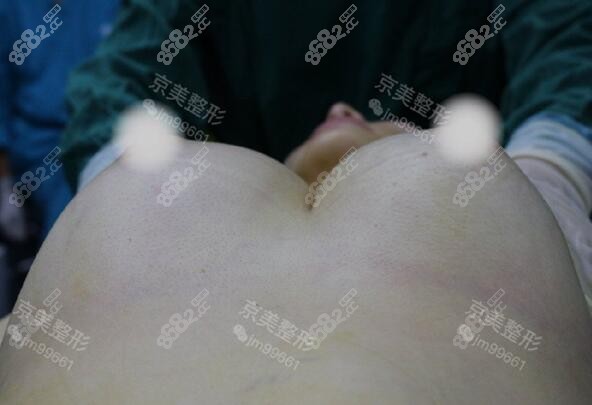 自体脂肪丰胸术后即刻效果图片