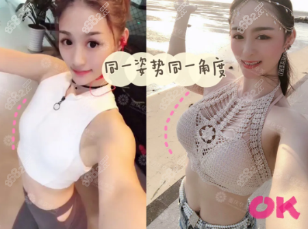 重庆华美陈德法隆胸案例