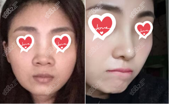 <!--<i data=20240705-sp></i>-->醫(yī)生做射極峰假體隆鼻案例四