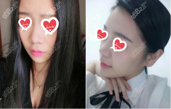 <!--<i data=20240705-sp></i>-->醫(yī)生做射極峰假體隆鼻案例三：