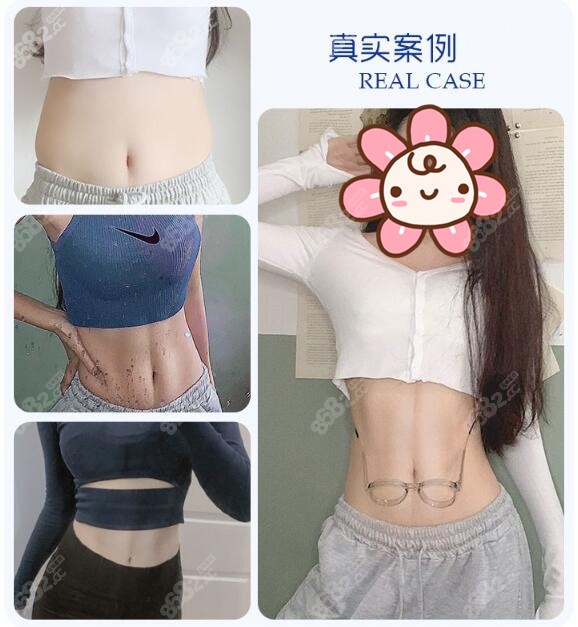 曹飞超医生高难度马甲线吸脂塑形案例