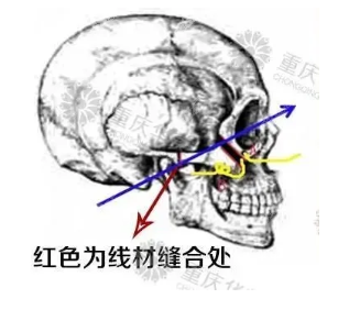 磨骨部位图示