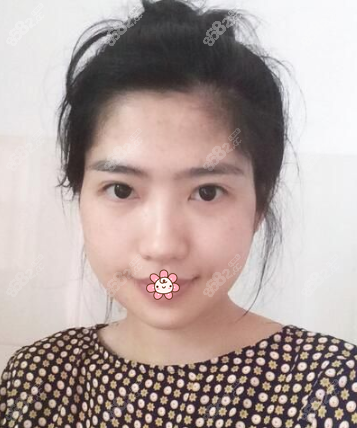 <!--<i data=20240705-sp></i>-->下颌角术后一个月