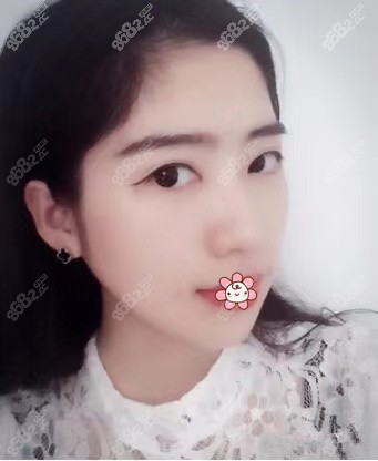 宽大的咬肌没了