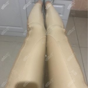 找成都潘红伟医生做大腿吸脂术后9天