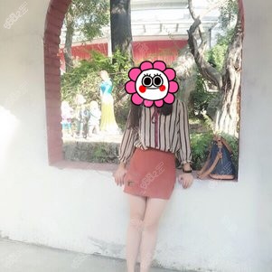找成都潘红伟医生做大腿吸脂术后5个月