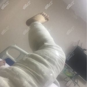 找成都潘红伟医生做大腿吸脂手术当天