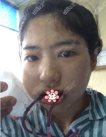 我在冰敷