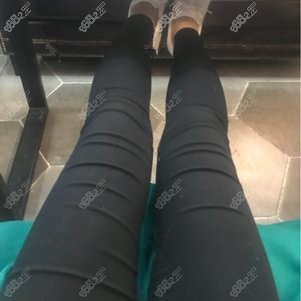 找成都潘红伟医生做大腿吸脂术后2个月