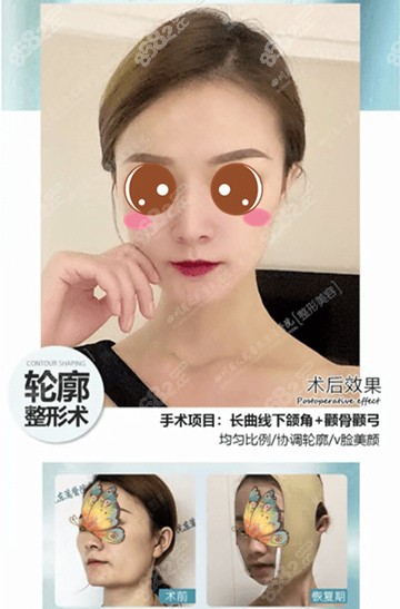 成都哪里做颧骨颧弓整形好