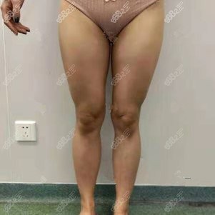 找成都潘红伟医生做大腿吸脂术前