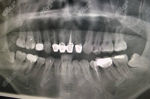 把智齿前需要拍片检查